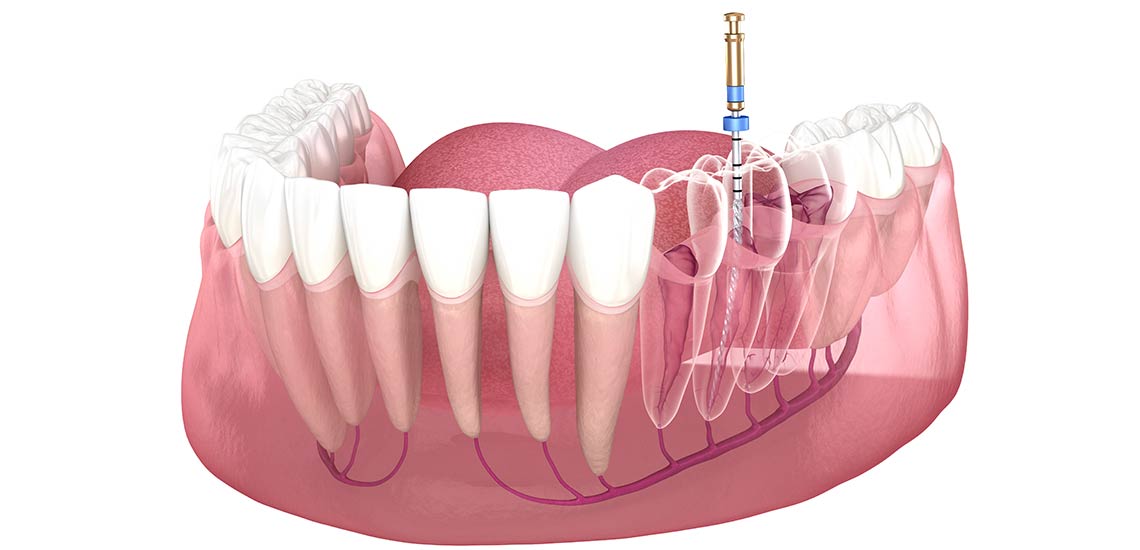 Endodoncia